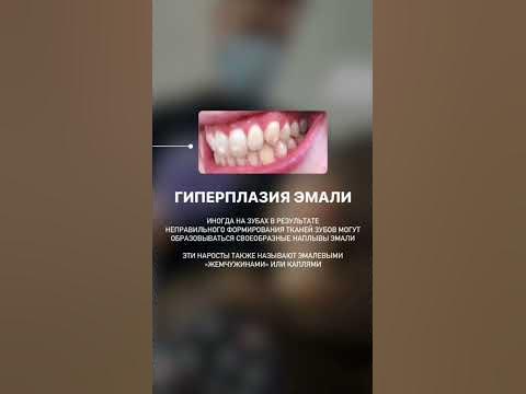 Гиперплазия эмали #зубы #shortvideo #стоматолог #shots #клиника # ...