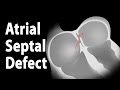 Atrial Septal Defect (ASD), Animation.