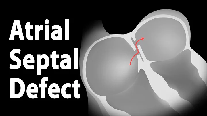 Atrial Septal Defect (ASD), Animation. - DayDayNews