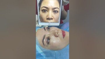 Cắt mí và điều chỉnh lại cân cơ nâng mi | Bác Sỹ Tuấn Dương