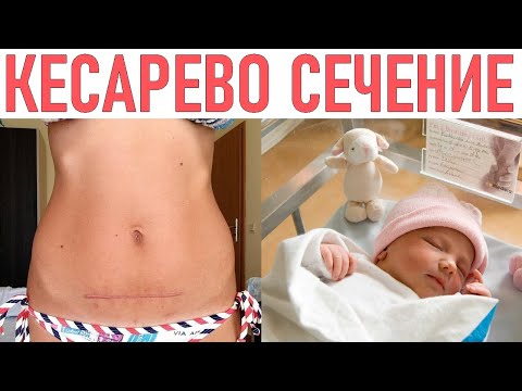 КЕСАРЕВО СЕЧЕНИЕ | 15 главных мифов о кесаревом сечении