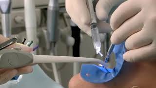 Endodontic Disinfection: Power of the Hand-Held Syringe: Advanced Endodontics: Dr. Cliff Ruddle