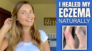 How I Healed My Eczema & Psoriases Naturally!