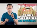 ⚠️Esta es la caries más peligrosa ¿Cómo evitarla? | Colaboración Oral B