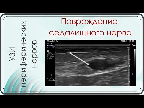 Повреждение седалищного нерва
