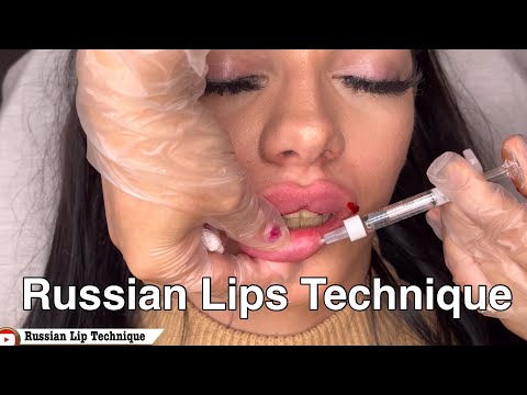 Russian Lips using Revolax Deep - Watch Till End - Full Tutorial Video