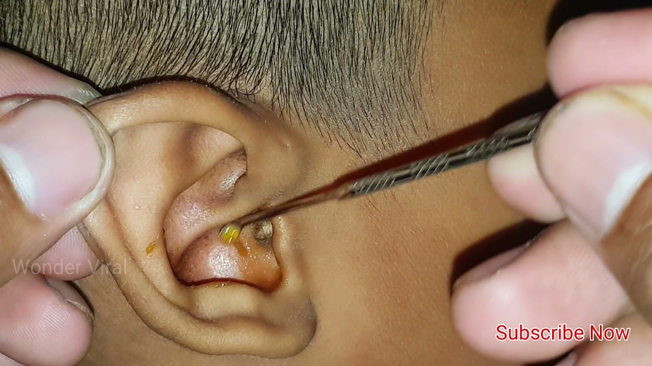 귀지 제거 (Cerumen Impaction) 건조한 귀지제거 / 고막에 붙은 귀지 (ear wax removal)[귀팡