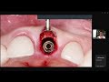 WEBINAR ONLINE: CẤY GHÉP IMPLANT TỨC THÌ - BVC LẠI THANH MINH