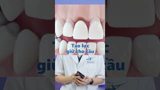 Cầu răng sứ có tốt không? | Lạc Việt Intech Implant #lvnw #short #metub