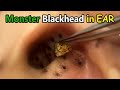 Monster Blackhead in Ear