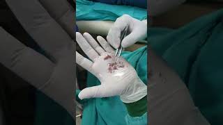All Steps of Hair Transplant surgery | Apex Hair Transplant Clinic Noida | #shorts #hairtransplant
