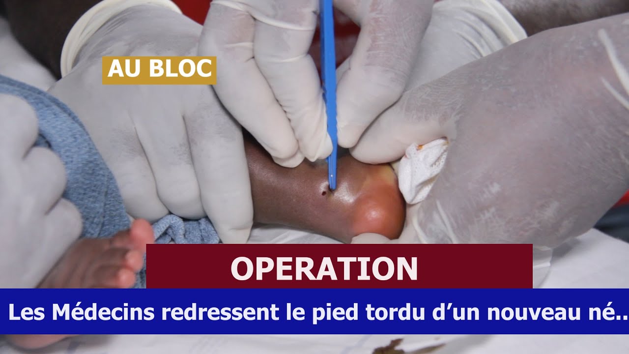 Chirurgie Un Enfant De 3 Semaines Opere De Pied Bot Regardez Cette Seance De Tenotomie Youtube