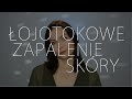 Łojotokowe zapalenie skóry