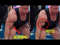 Los Biceps que Lloran (Ruptura del Tendón Distal del Biceps)