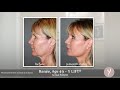 Y lift non surgical facial contouring