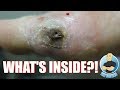 EXTREME FOOT INJURY UNBELIEVABLE REMOVAL!!! WHAT’S STUCK IN THIS FOOT??? FOOT HEALTH MONTH 2018 #1