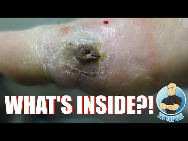 EXTREME FOOT INJURY UNBELIEVABLE REMOVAL!!! WHAT’S STUCK IN THIS FOOT??? FOOT HEALTH MONTH 2018 #15 class=