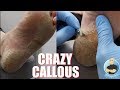 SUPER THICK HARD SKIN SCRAPPING ***EXTREME CALLOUS REMOVAL***