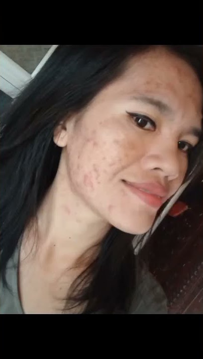 Testimoni real pemakaian sabun leafhea! Jerawat parah sembuh😱 #sabunbpom #sabunjerawat#shorts