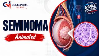 Seminoma Quick Review Animation for USMLE | Testicular Cancer Diagnosis & Management