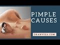 मुँहासे के कारण : Dr. Anvika