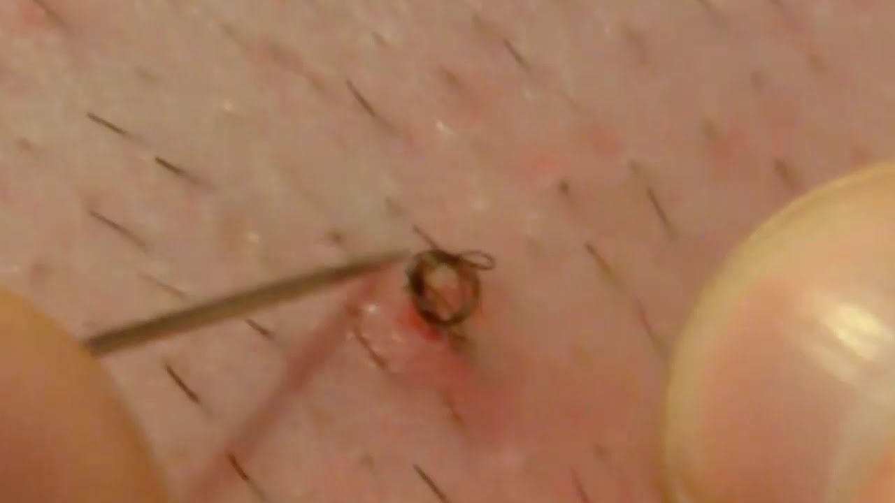 INGROWN HAIR YouTube