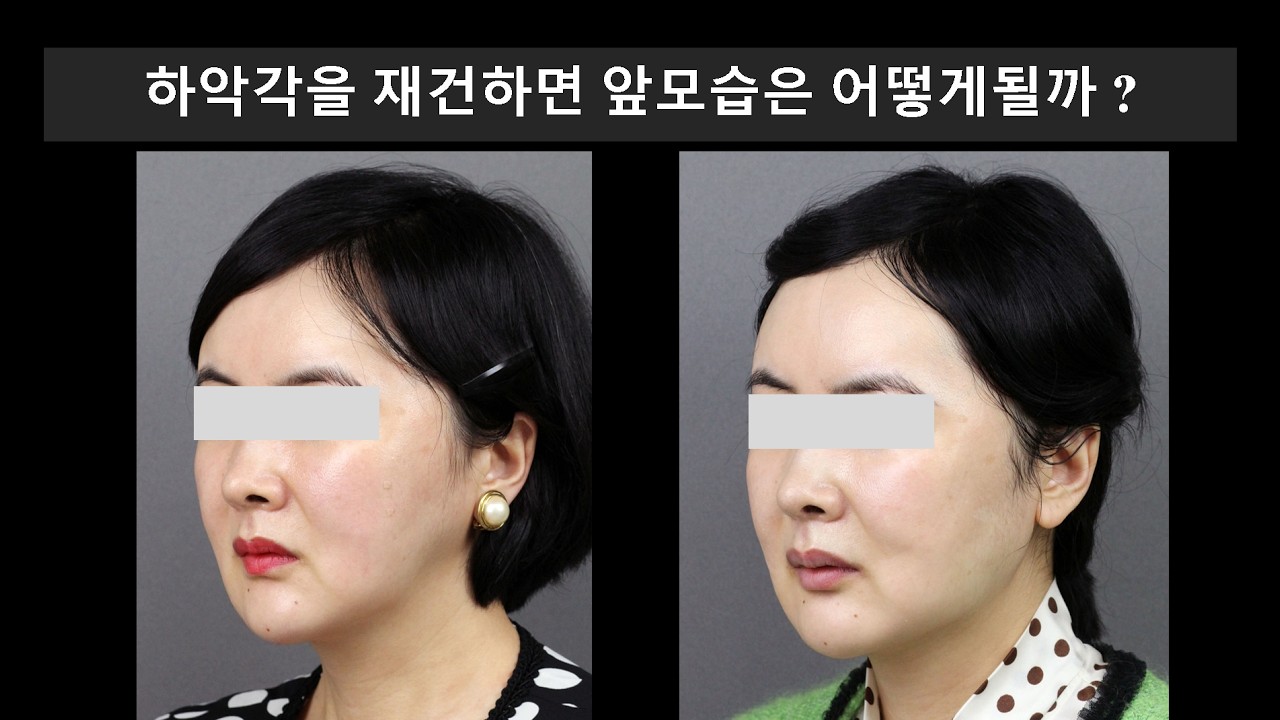 Как будет выглядеть фронтальный вид после реконструкции угла нижней челюсти? (Реконструкция угла ...
