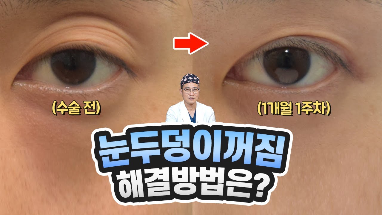 눈두덩이 꺼짐 교정 (루프지방이식) | 압구정김원장