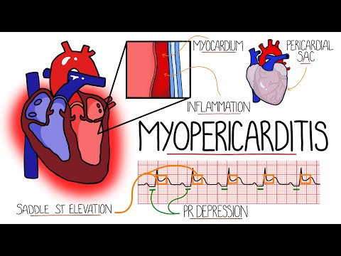 Video: Kokie yra miokardito ir perikardito simptomai?