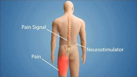 How Spinal Cord Stimulation Works