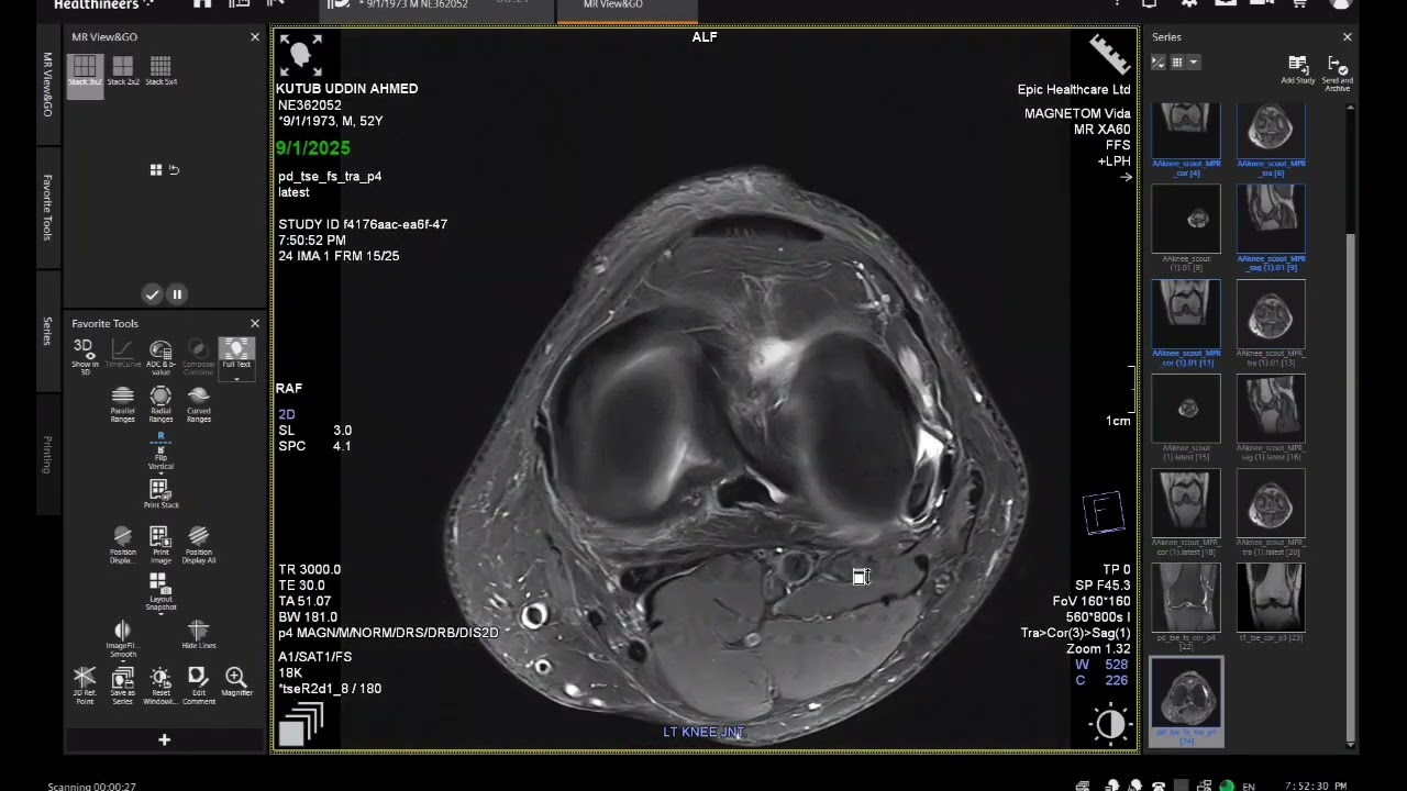 MRI Knee Joint Techniques, Planning & Filming || Siemens Magnetom Vida 3T || 