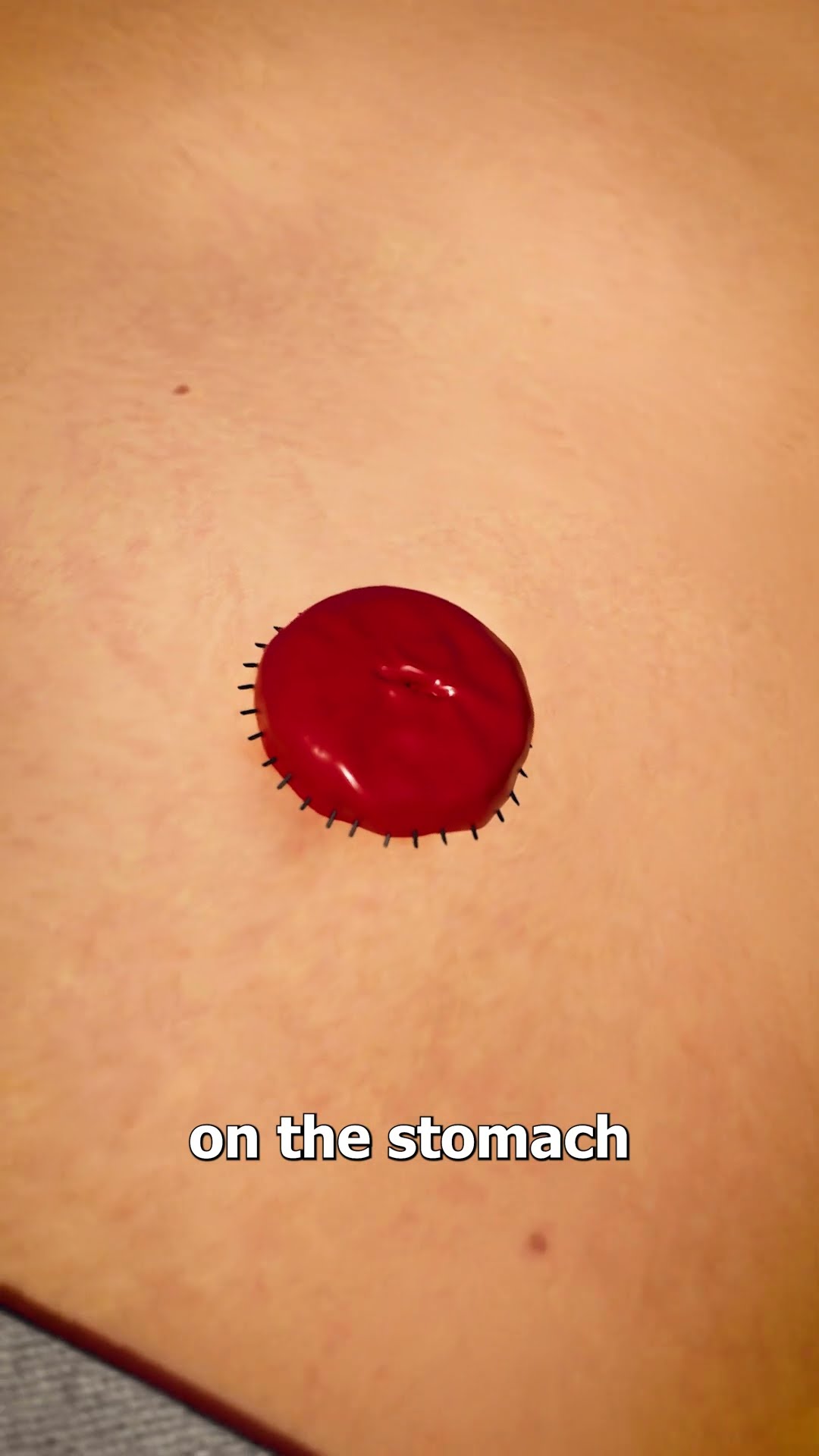 How A Colostomy Bag Works ?