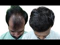Hair transplant cost nagpur  hair transplant results  new roots 