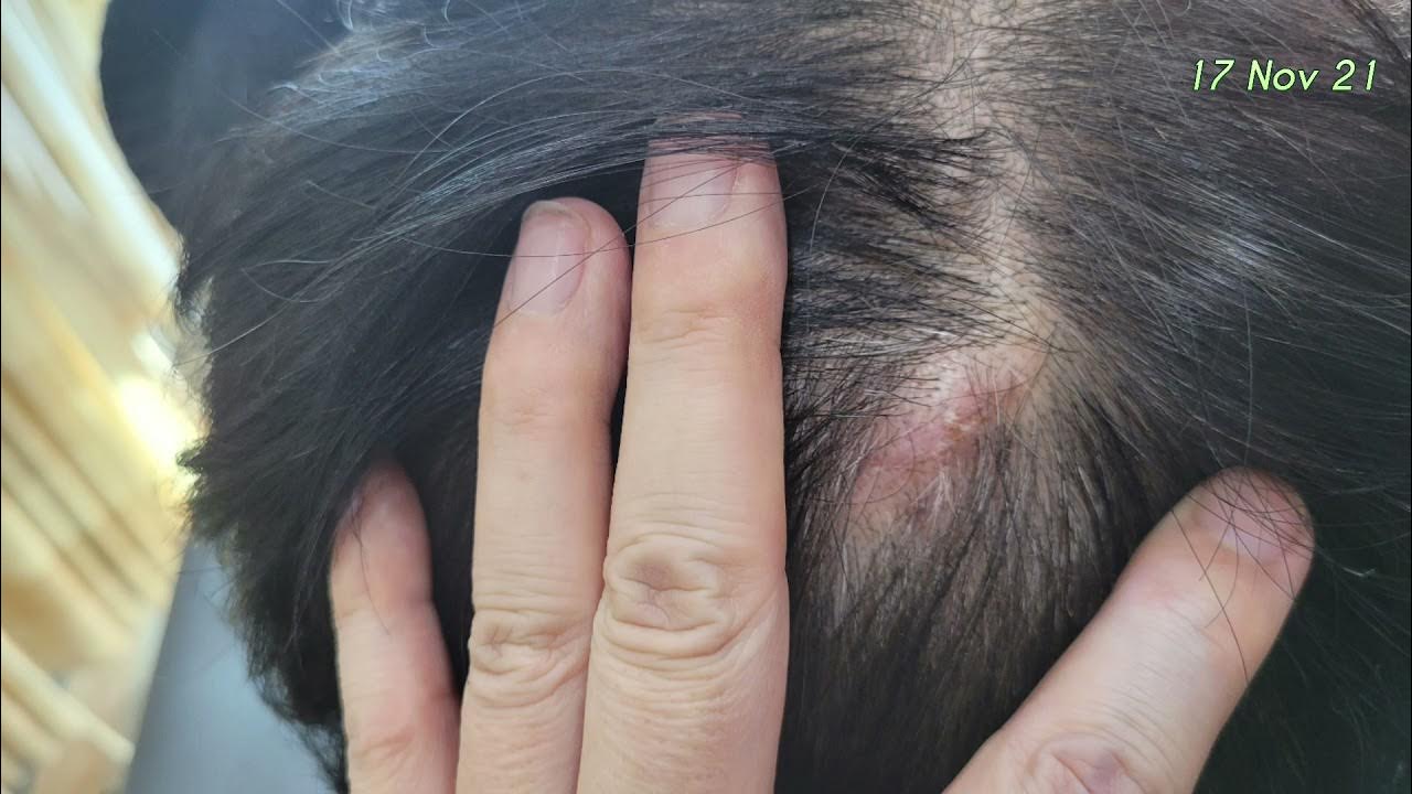 머리에 발생한 지방종.... 그리고 얼굴의 표피낭. Lipoma On The Scalp And Cyst On The Cheek,  Trichofolliculoma - Youtube