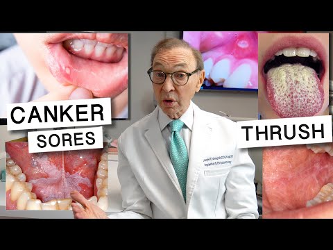 Video: Kodėl vidinis burnos odos lupimasis?