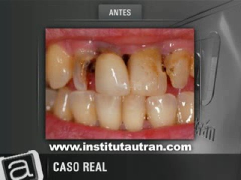 Estética dental: casos extremos (problema y solución)