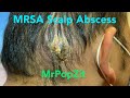 Giant MRSA Abscess on scalp. Incision and drainage with packing. 24 hour and 7 day follow up.