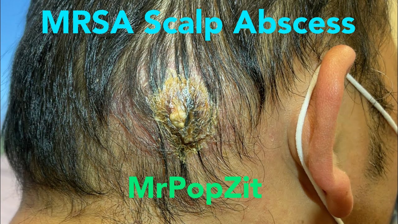 Måltid kløft Mobilisere Giant MRSA Abscess on scalp. Incision and drainage with packing. 24 hour  and 7 day follow up. - YouTube
