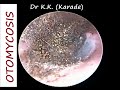 Micro-suction Cleaning of Black Fungus (Otomycosis) from Ear Canal - Full HD Unedited