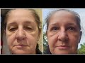 Antes e depois da cirurgia das pálpebras (blefaroplastia)