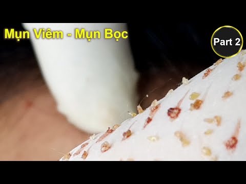 Video Điều trị mụn viêm - mụn bọc hiệu quả | Part 2 |. Tại... - youtube