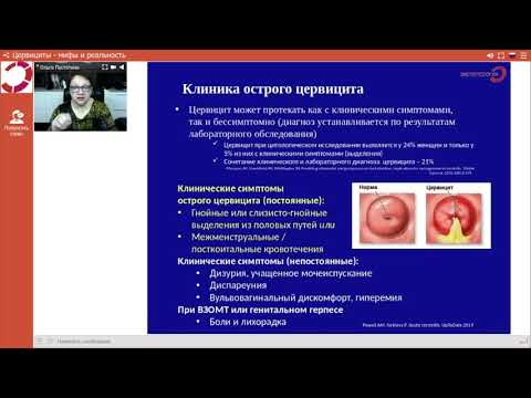 Экспертология | Цервициты мифы и реальность