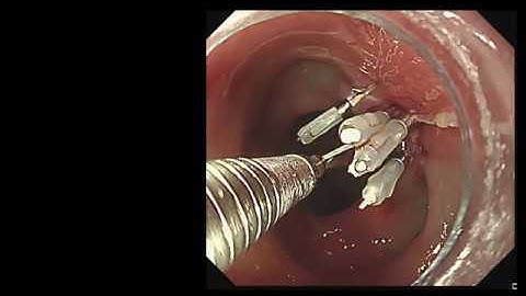 Clip with line for post ESD wound closure