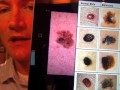 Mole vs Melanoma
