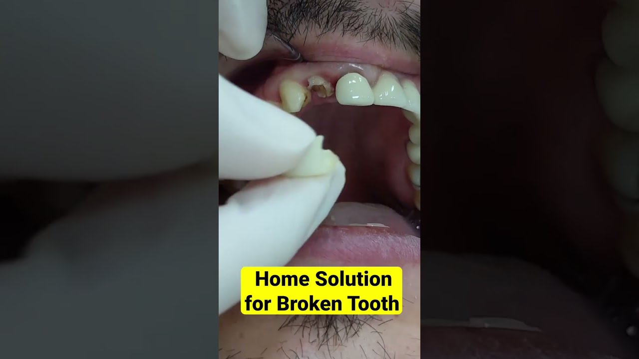 Quick Home Solution for Broken Tooth #shorts