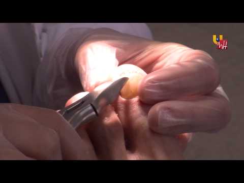Vídeo: Onicogrifosis (uñas De Cuerno De Carnero): Causas Y Tratamiento