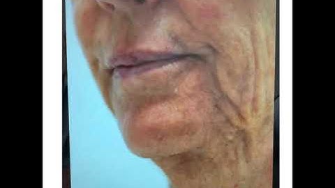 Dr. Calabria Explains the Secret to the Facelift: The Ogee Curve