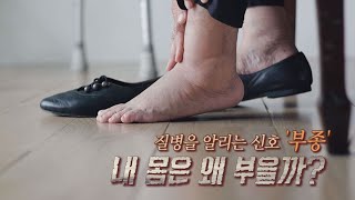 TV메디컬 약손_부종(영남대병원 순환기내과 손장원교수)