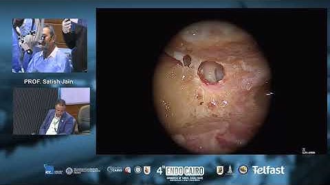 4th Endocairo - Day 3, Lateral skull base dissection (3) Prof Satish Jain.