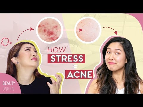  Signs +  Easy Cures to Prevent ACNE and STRESSED Skin